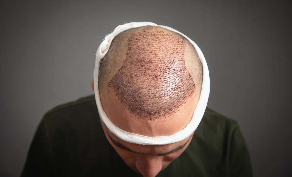 Best Hair Transplant Surgeon in Faridabad