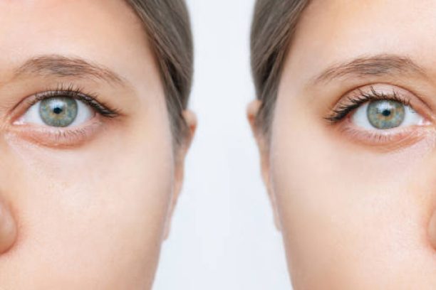 Close up of a young caucasian woman's face with drooping upper eyelid before and after blepharoplasty isolated on white background. Result of plastic surgery. Changing the shape, cut of the eyes