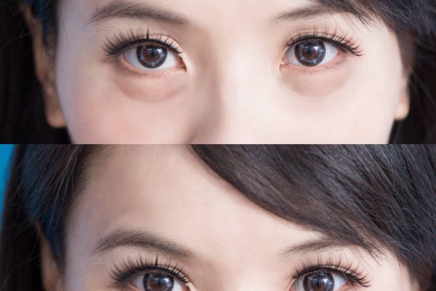 woman eye bags vefore and after on the blue background