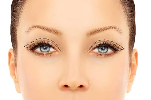 Marking the face.Upper-Eyelid Blepharoplasty