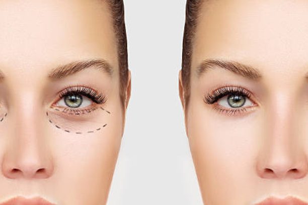 Marking the face.Lower-Eyelid BlepharoplastyCorrecting  the aging process.Perforation lines on females face, plastic surgery concept.