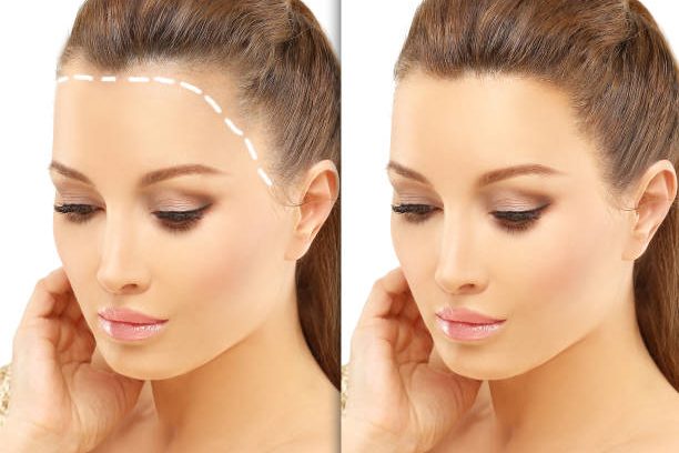 Alopecia Areata,female pattern baldness,Treatment for hair loss,Hair transplant,Surgery to implant artificial hairs